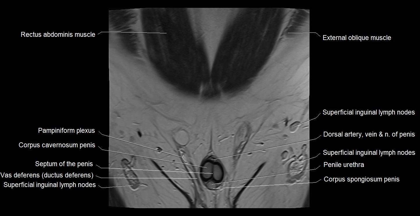 MRI coronal cross sectional anatomy male pelvis image 1.webp